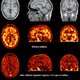 Caffeine blocks receptors in the brain that would normally attach to adenosine, an enzyme that makes you drowsy.